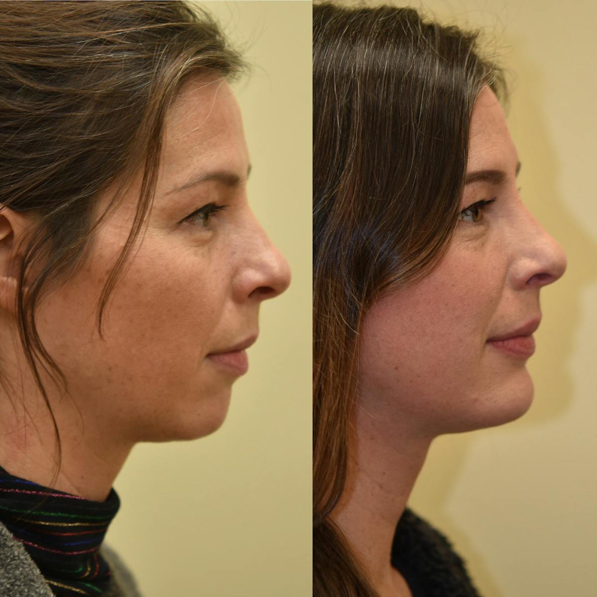 Chin Implant Before & After Gallery - Patient 187362 - Image 3