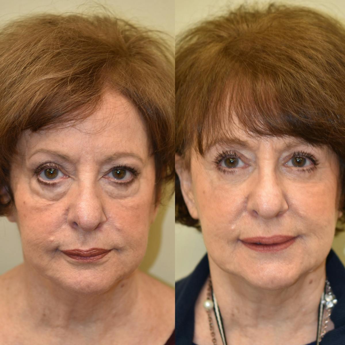 Eyelid Surgery Before & After Gallery - Patient 336302 - Image 1