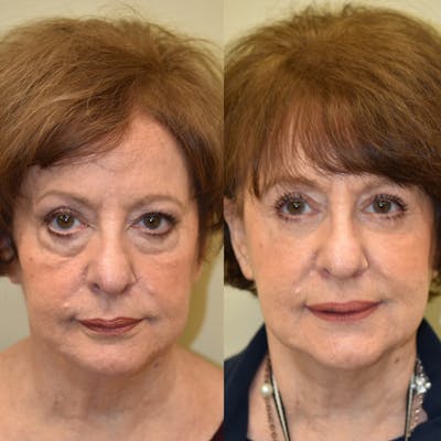 Eyelid Surgery Before & After Gallery - Patient 336302 - Image 1