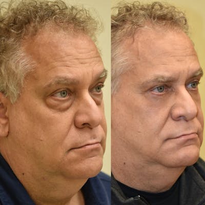Fat Transfer Before & After Gallery - Patient 349367 - Image 1