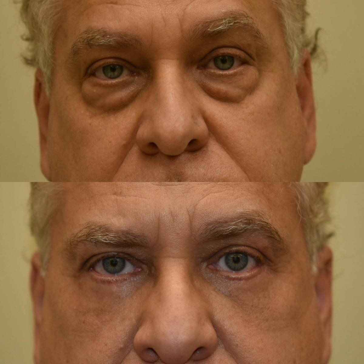 Fat Transfer Before & After Gallery - Patient 349367 - Image 2