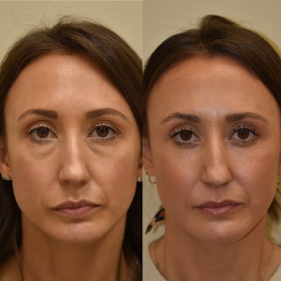 Fat Transfer Before & After Gallery - Patient 347990 - Image 1
