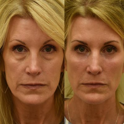 Fat Transfer Before & After Gallery - Patient 400205 - Image 1