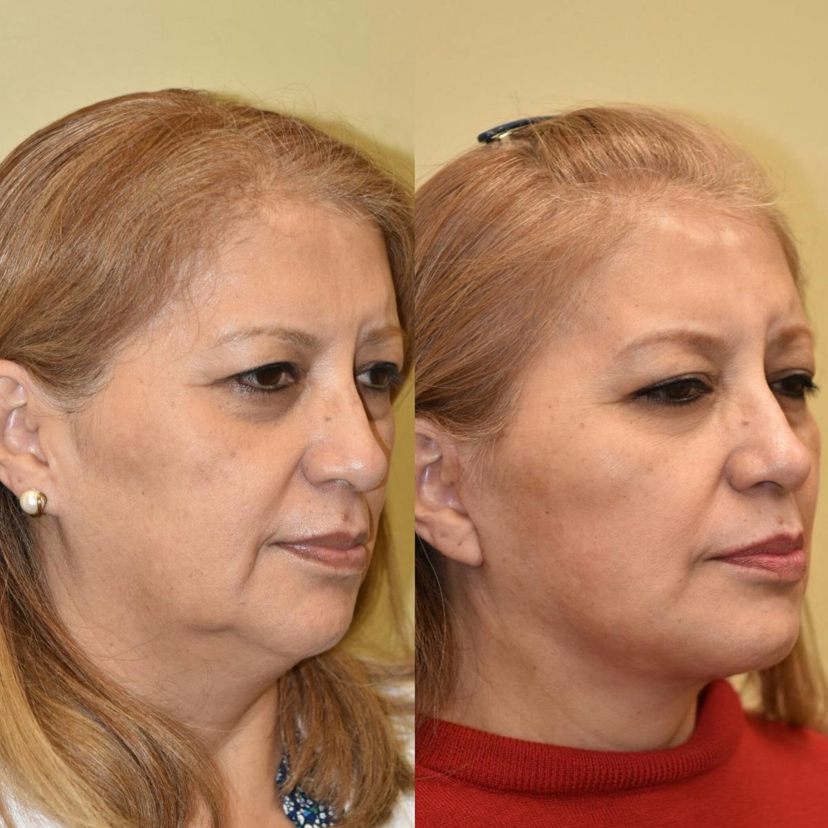 Facelift Before & After Gallery - Patient 248578 - Image 1