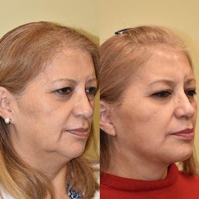 Neck Lift Before & After Gallery - Patient 487453 - Image 1