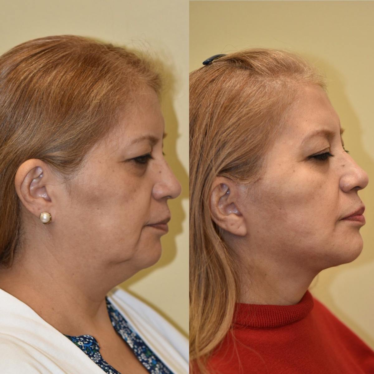 Facelift Before & After Gallery - Patient 248578 - Image 3