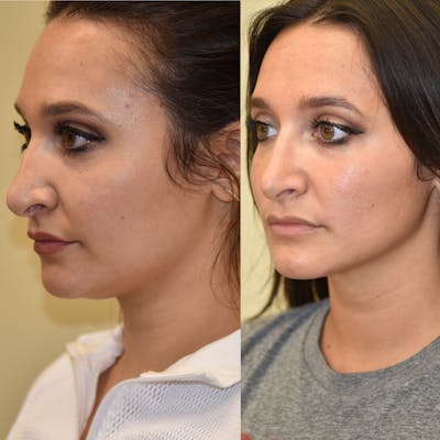 Face Liposuction Before & After Gallery - Patient 227474 - Image 1