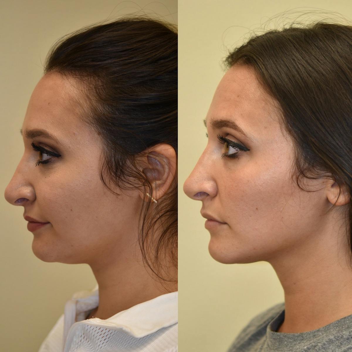 Face Liposuction Before & After Gallery - Patient 227474 - Image 2