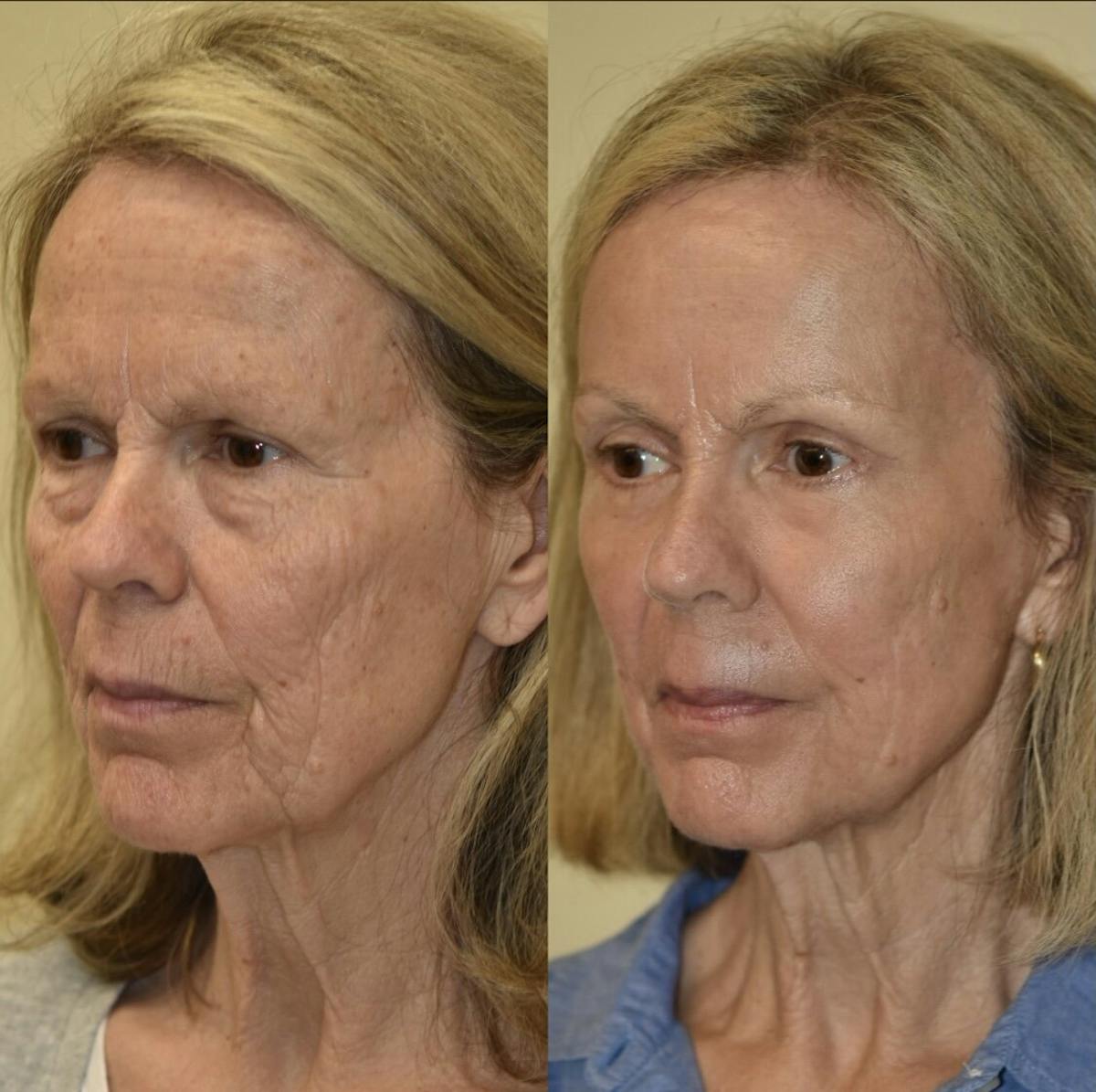 Fat Transfer Before & After Gallery - Patient 151979 - Image 1