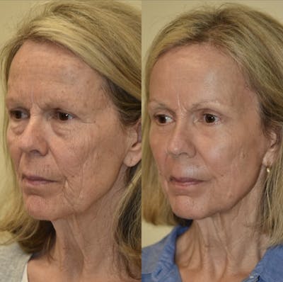 Fat Transfer Before & After Gallery - Patient 151979 - Image 1