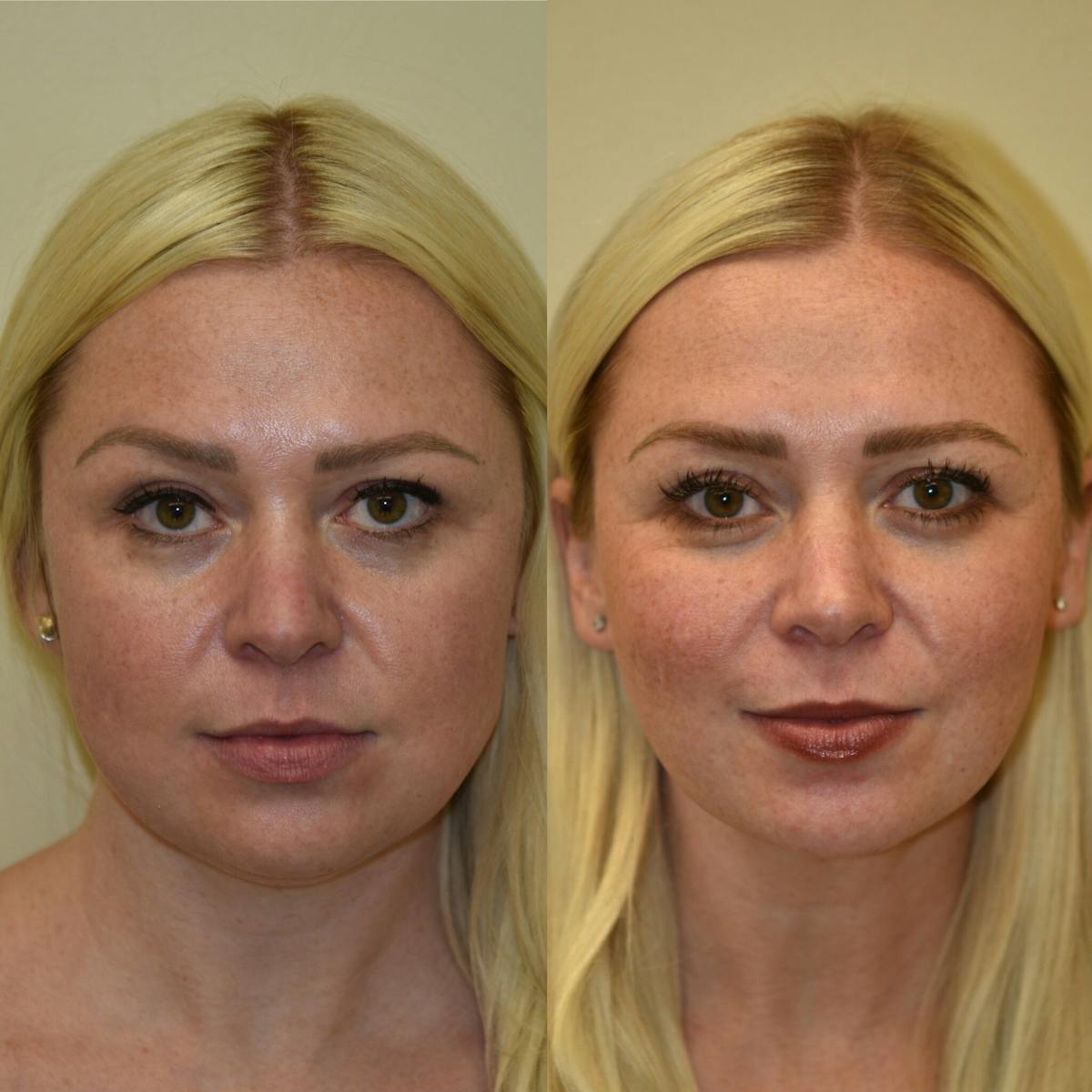 Face Liposuction Before & After Gallery - Patient 268621 - Image 1
