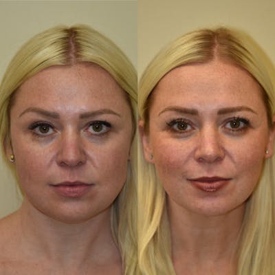 Buccal Fat Reduction Before & After Gallery - Patient 321290 - Image 1