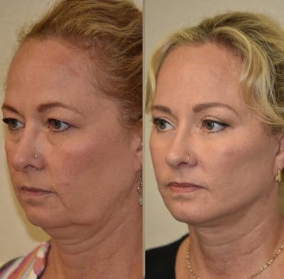 Facelift Before & After Gallery - Patient 731003 - Image 1