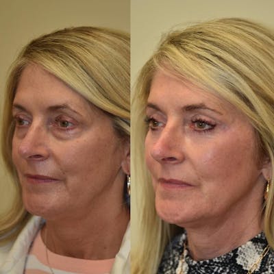 Fat Transfer Before & After Gallery - Patient 242675 - Image 1
