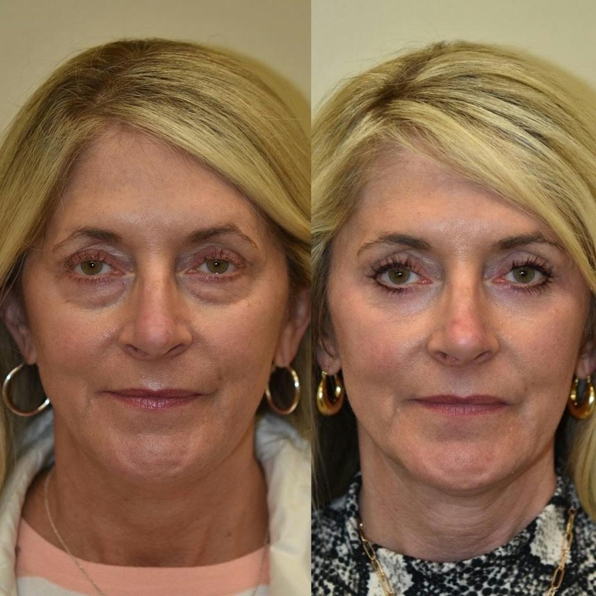 Fat Transfer Before & After Gallery - Patient 242675 - Image 2