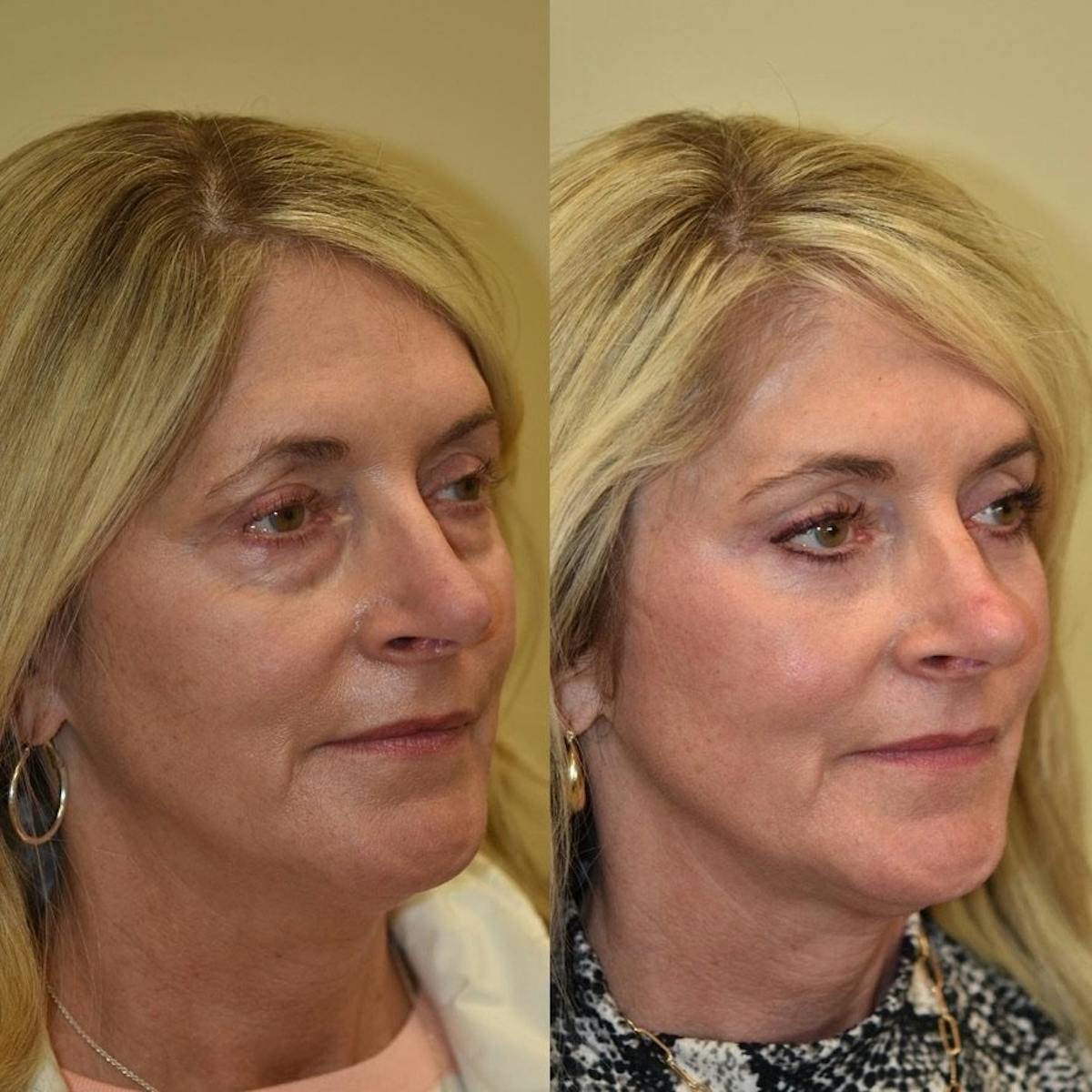 Fat Transfer Before & After Gallery - Patient 242675 - Image 3