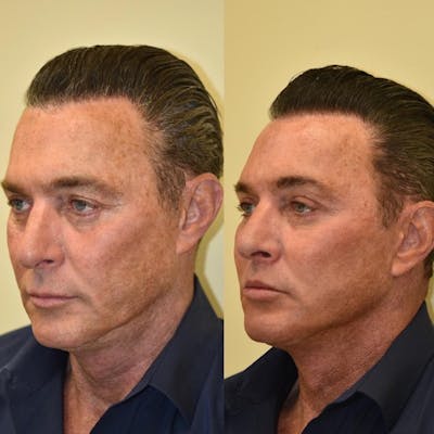 Neck Lift Before & After Gallery - Patient 719508 - Image 1