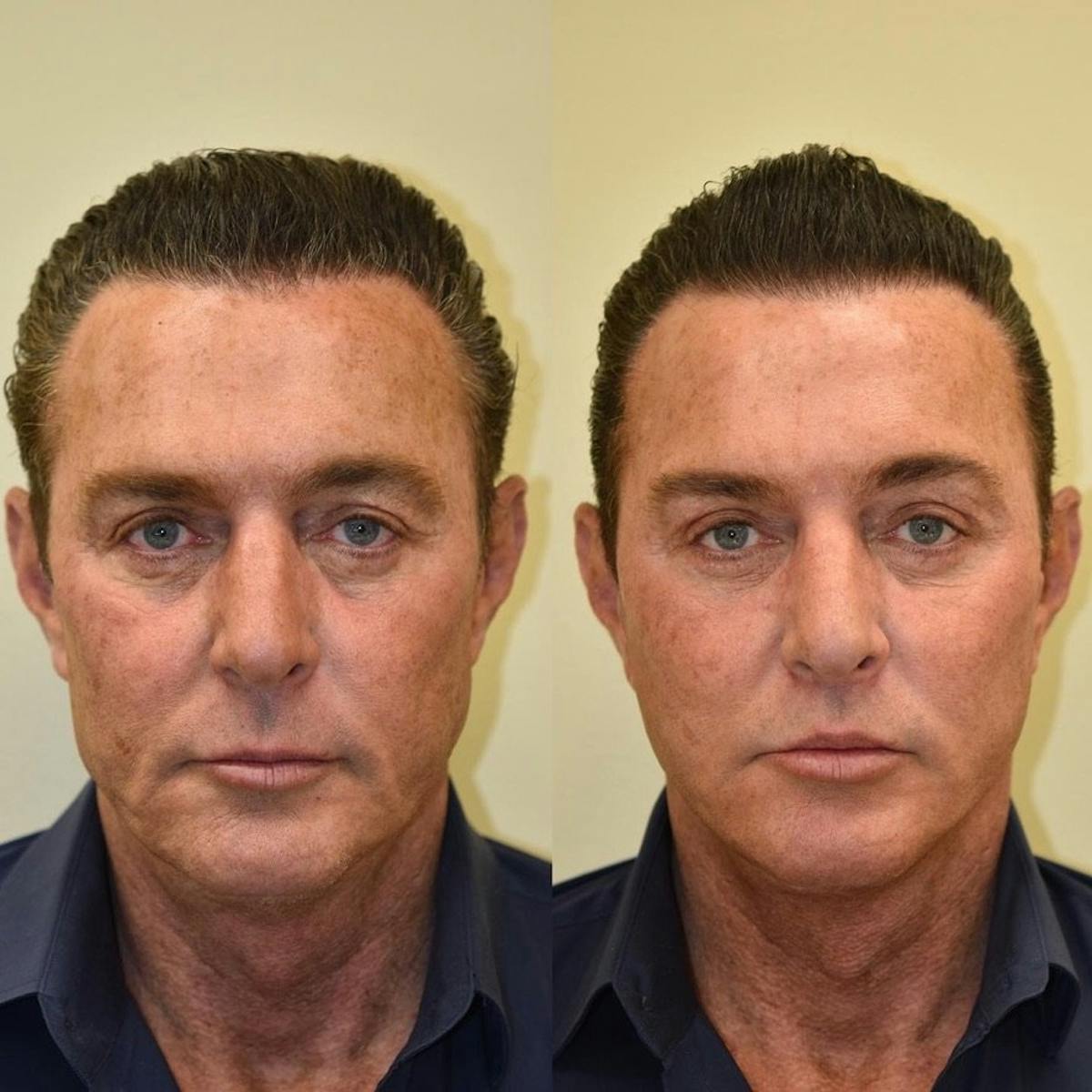 Facelift Before & After Gallery - Patient 269876 - Image 2