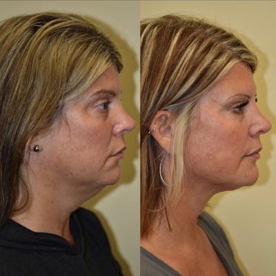 Neck Lift Before & After Gallery - Patient 376409 - Image 1