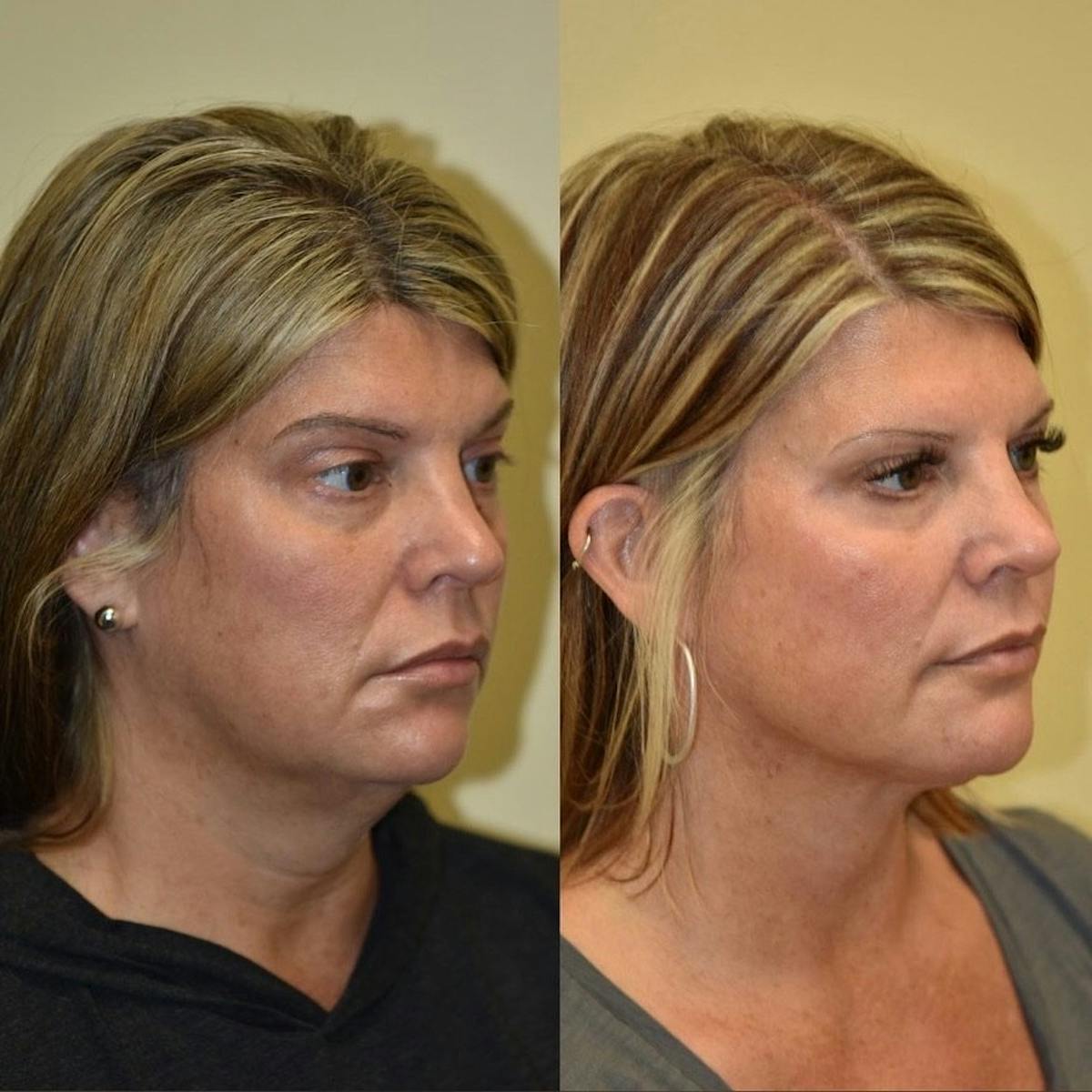 Face Liposuction Before & After Gallery - Patient 695877 - Image 2