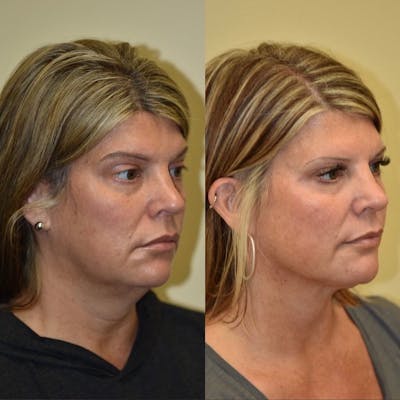 Neck Lift Before & After Gallery - Patient 376409 - Image 1