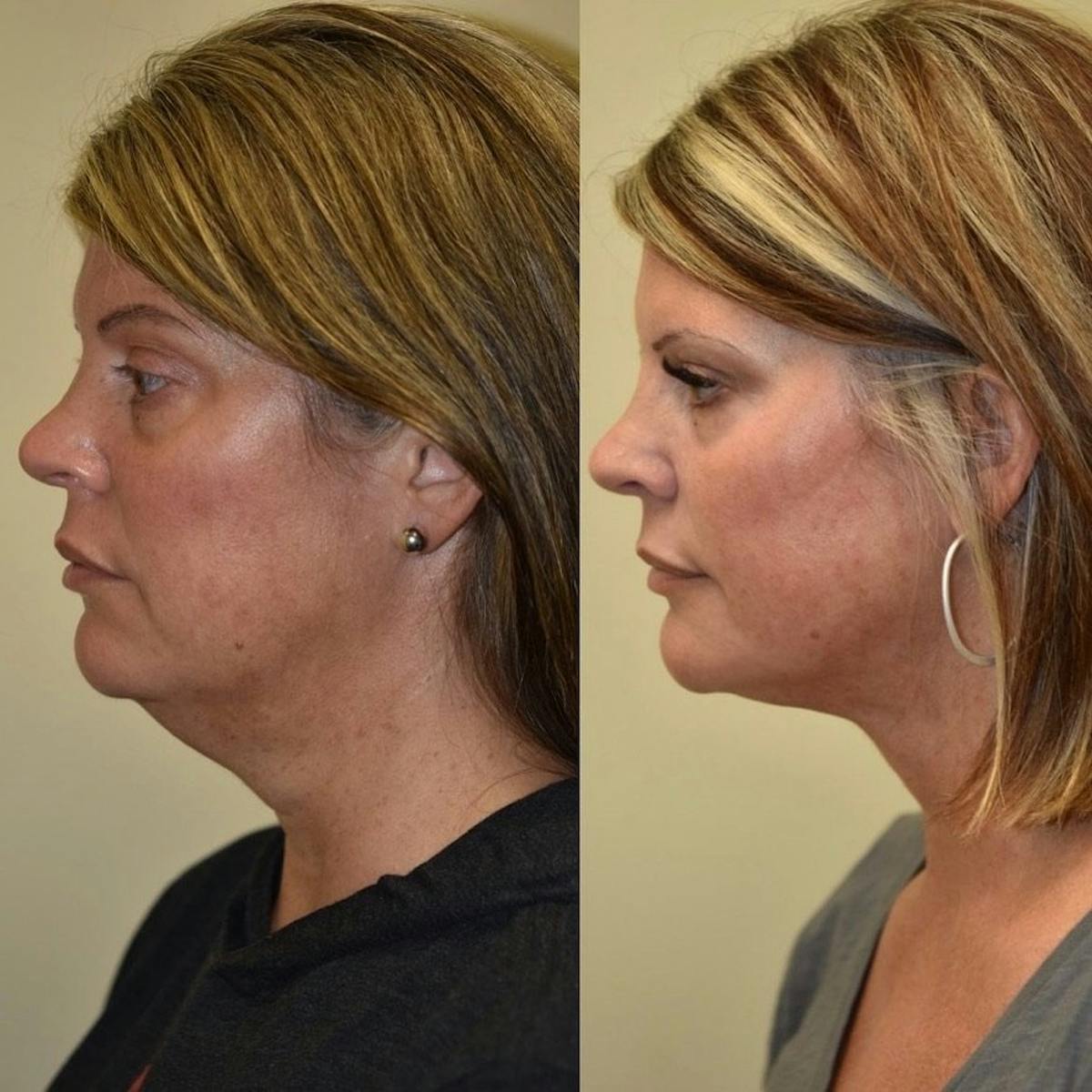 Face Liposuction Before & After Gallery - Patient 695877 - Image 3