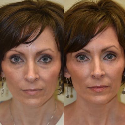 Fat Transfer Before & After Gallery - Patient 410265 - Image 1