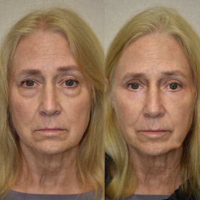 Eyelid Surgery Before & After Gallery - Patient 216678 - Image 1