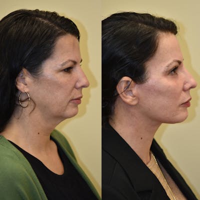 Neck Lift Before & After Gallery - Patient 346613 - Image 1