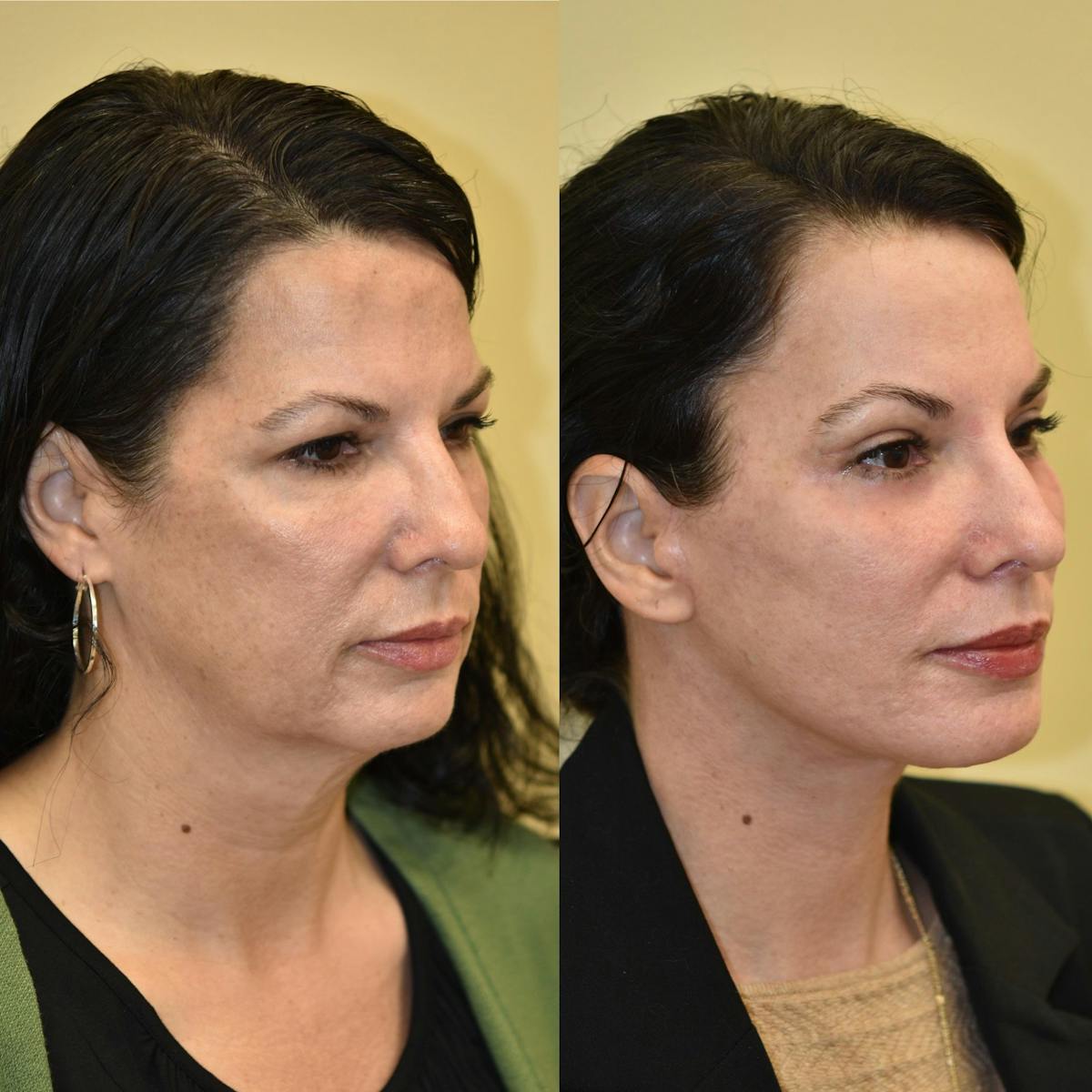 Brow Lift Before & After Gallery - Patient 315909 - Image 2