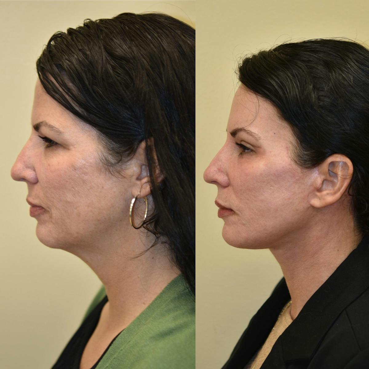 Brow Lift Before & After Gallery - Patient 315909 - Image 3
