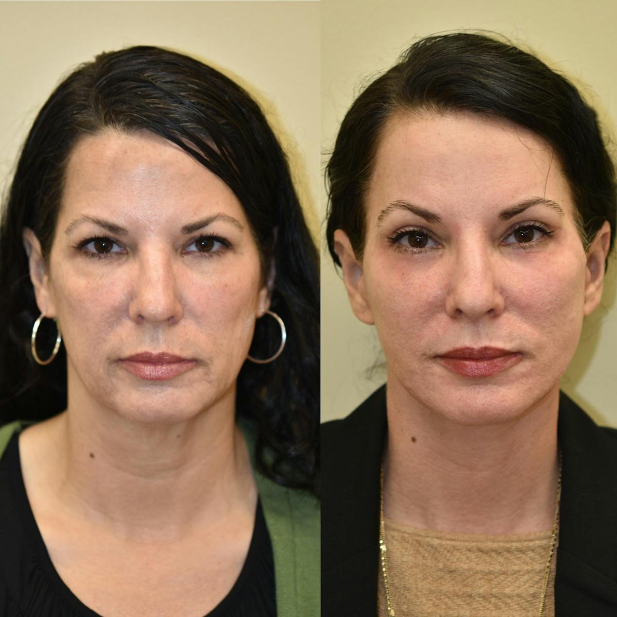 Brow Lift Before & After Gallery - Patient 315909 - Image 4
