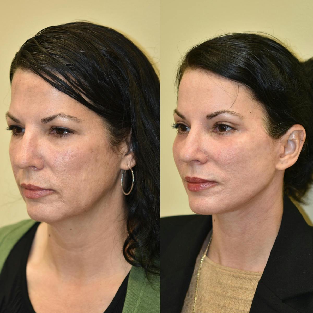 Brow Lift Before & After Gallery - Patient 315909 - Image 5