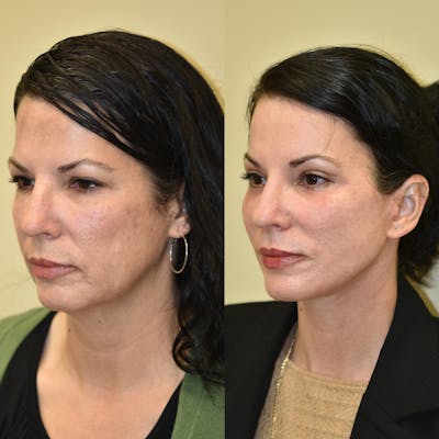 Neck Lift Before & After Gallery - Patient 346613 - Image 1