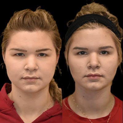 Buccal Fat Reduction Before & After Gallery - Patient 355254 - Image 1