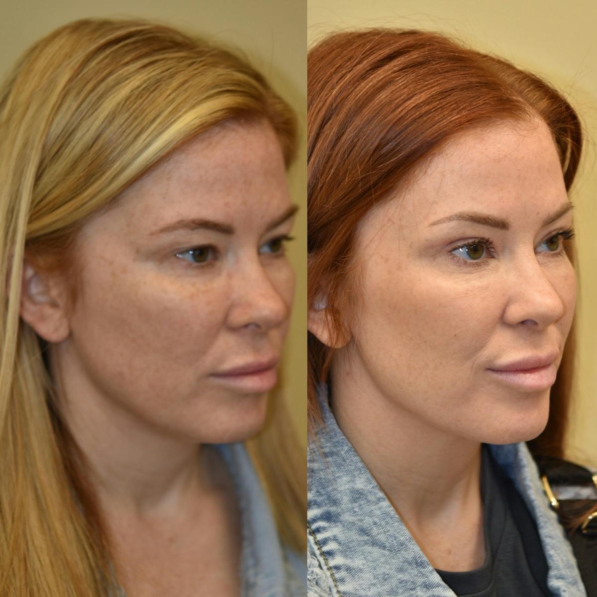 Brow Lift Before & After Gallery - Patient 507678 - Image 1
