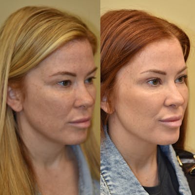 Brow Lift Before & After Gallery - Patient 507678 - Image 1