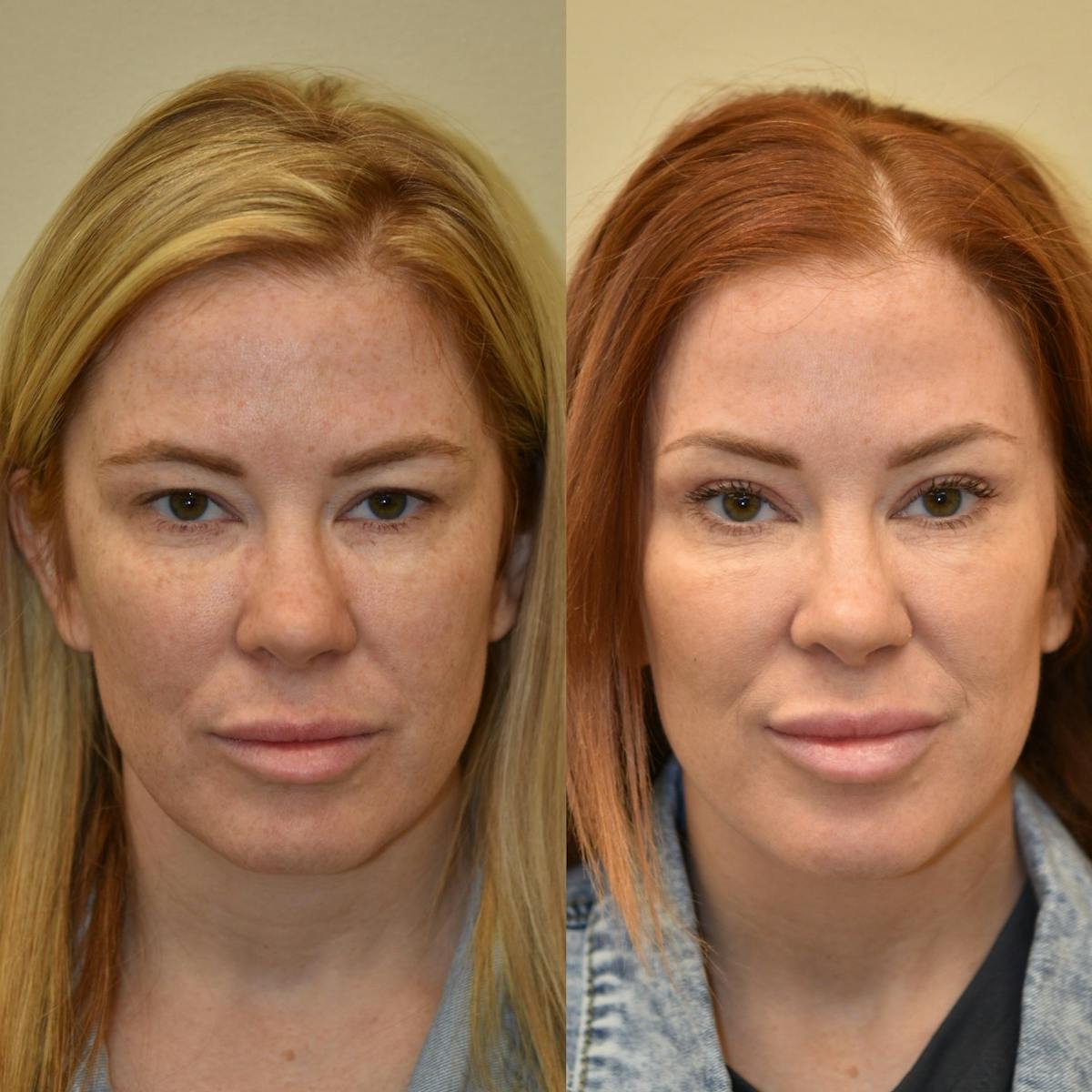 Brow Lift Before & After Gallery - Patient 507678 - Image 2