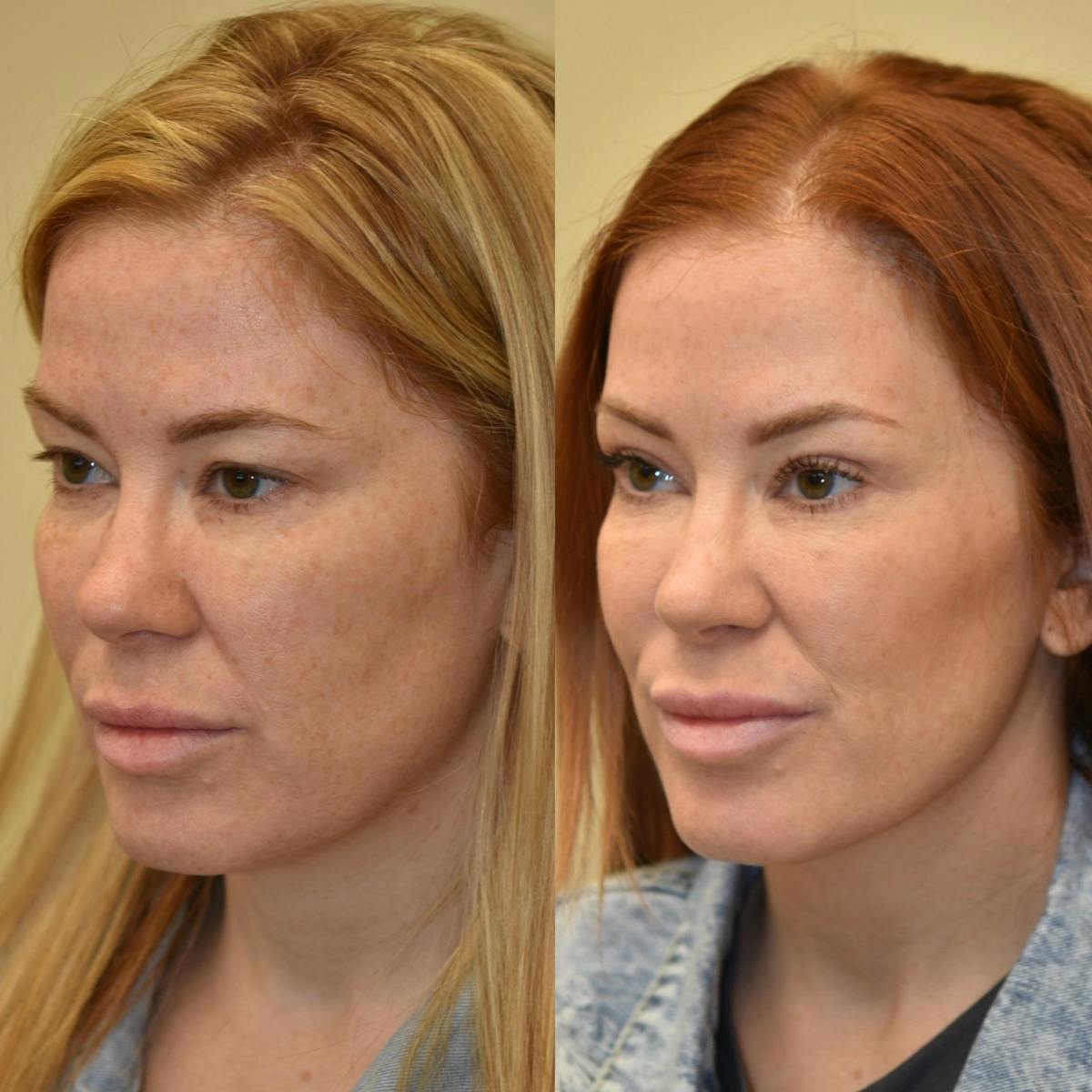 Brow Lift Before & After Gallery - Patient 507678 - Image 3