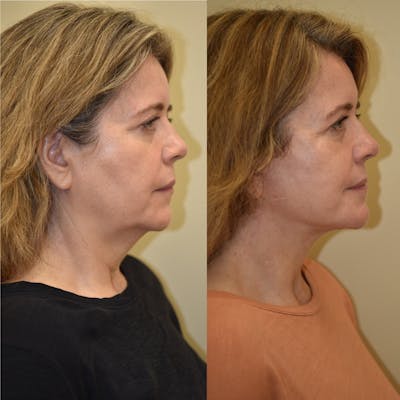 Neck Lift Before & After Gallery - Patient 183559 - Image 1