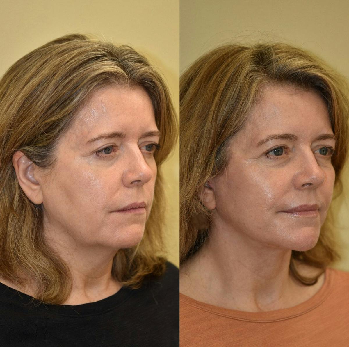 Facelift Before & After Gallery - Patient 549307 - Image 2