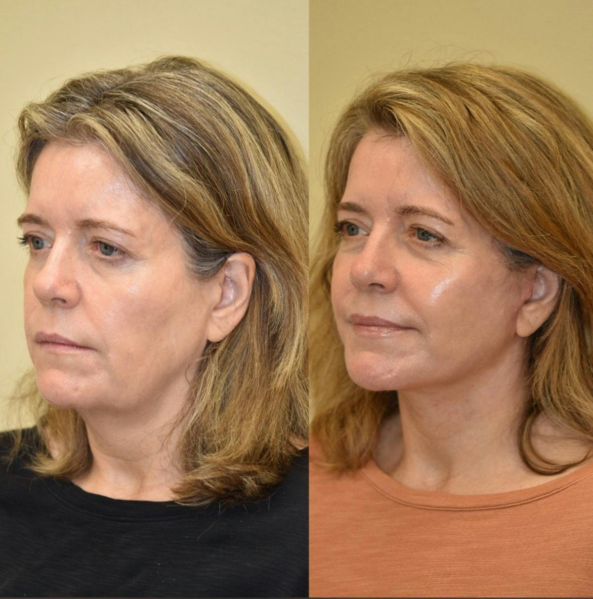 Facelift Before & After Gallery - Patient 549307 - Image 3