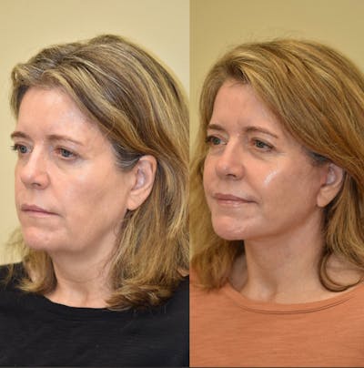 Neck Lift Before & After Gallery - Patient 183559 - Image 1