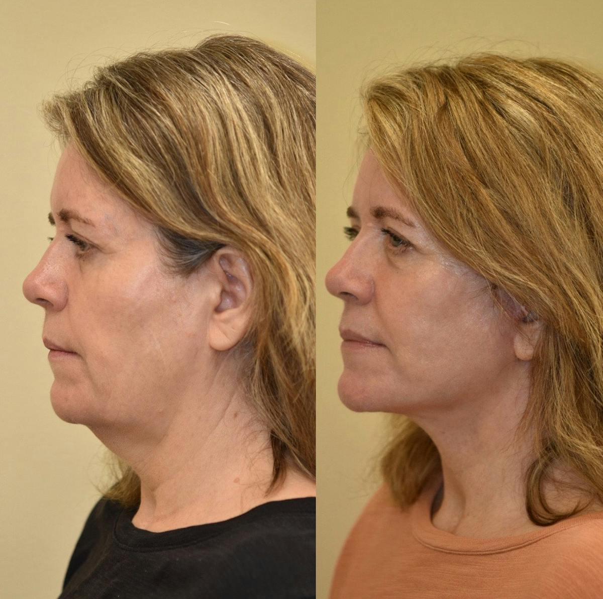 Facelift Before & After Gallery - Patient 549307 - Image 4