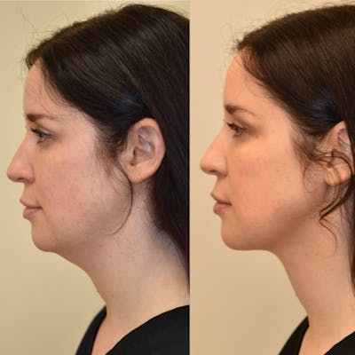 Face Liposuction Before & After Gallery - Patient 140384 - Image 1