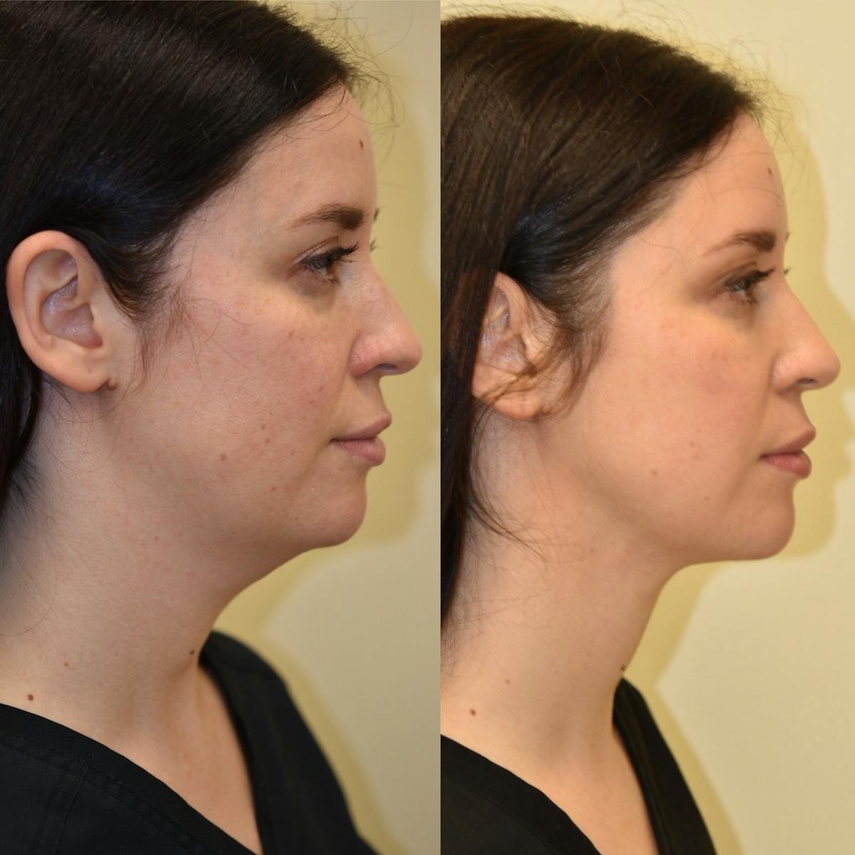 Face Liposuction Before & After Gallery - Patient 140384 - Image 2