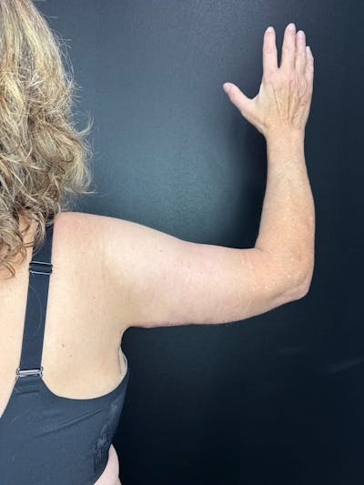 Arm Lift Before & After Gallery - Patient 321356 - Image 2