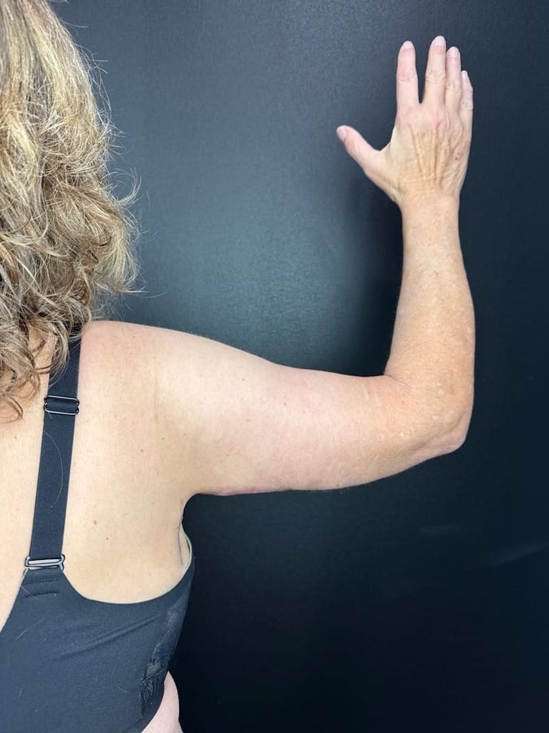 Arm Lift Before & After Gallery - Patient 321356 - Image 2