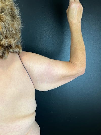 Arm Lift Before & After Gallery - Patient 321356 - Image 1