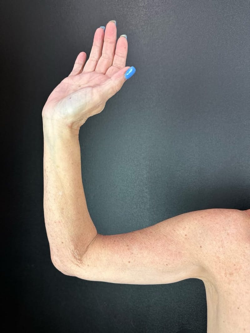Arm Lift Before & After Gallery - Patient 174459 - Image 2